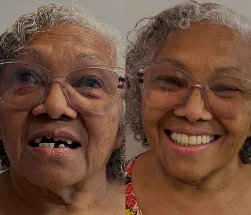 Paciente antes e depois da reabilitação oral no Jardim Botânico Odontologia