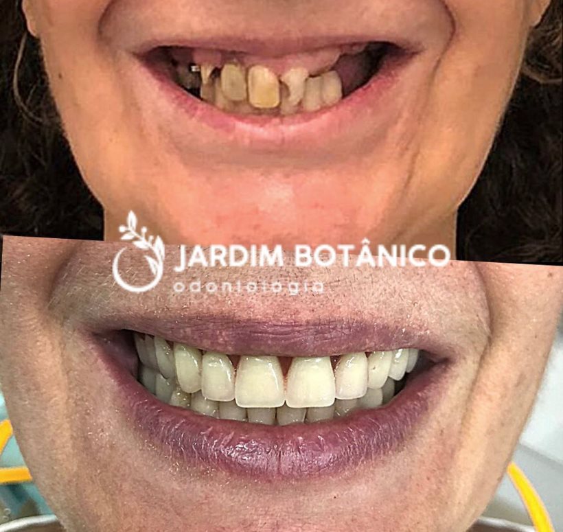 Antes e depois de paciente que recuperou os dentes superiores