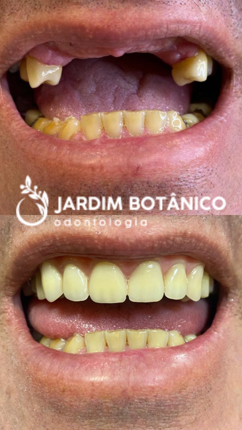 Resultado de reabilitação com dentes fixos em paciente da clínica