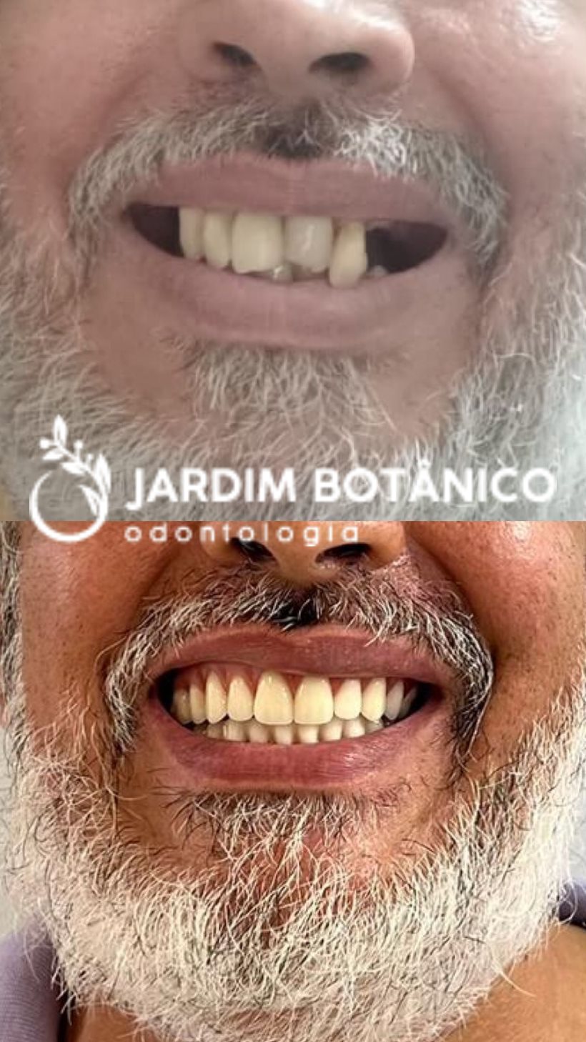 Paciente com o sorriso recuperado após o tratamento