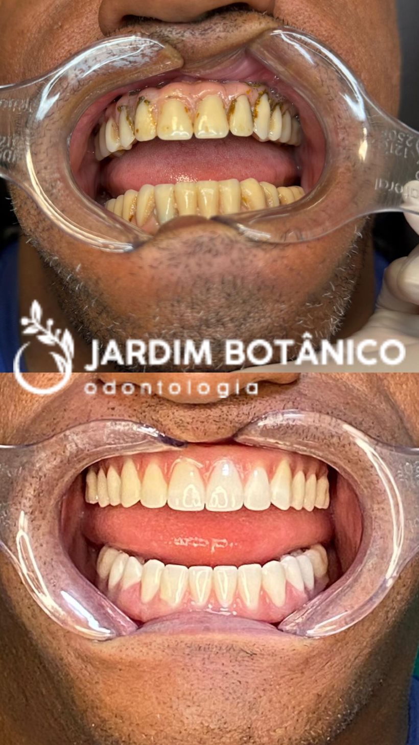 Transformação do sorriso com prótese sobre implantes