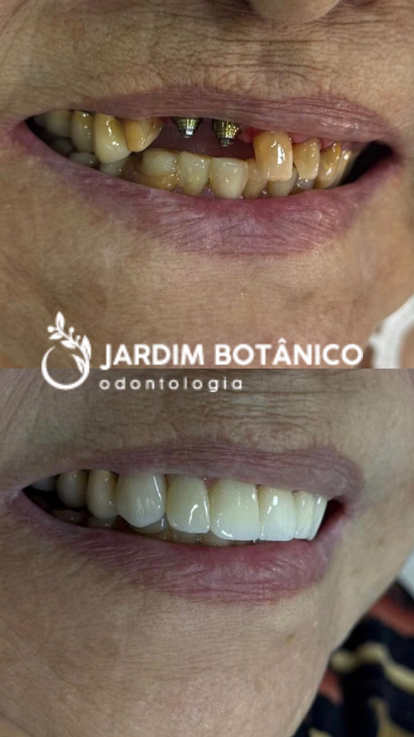 Antes e depois de paciente reabilitado com implantes