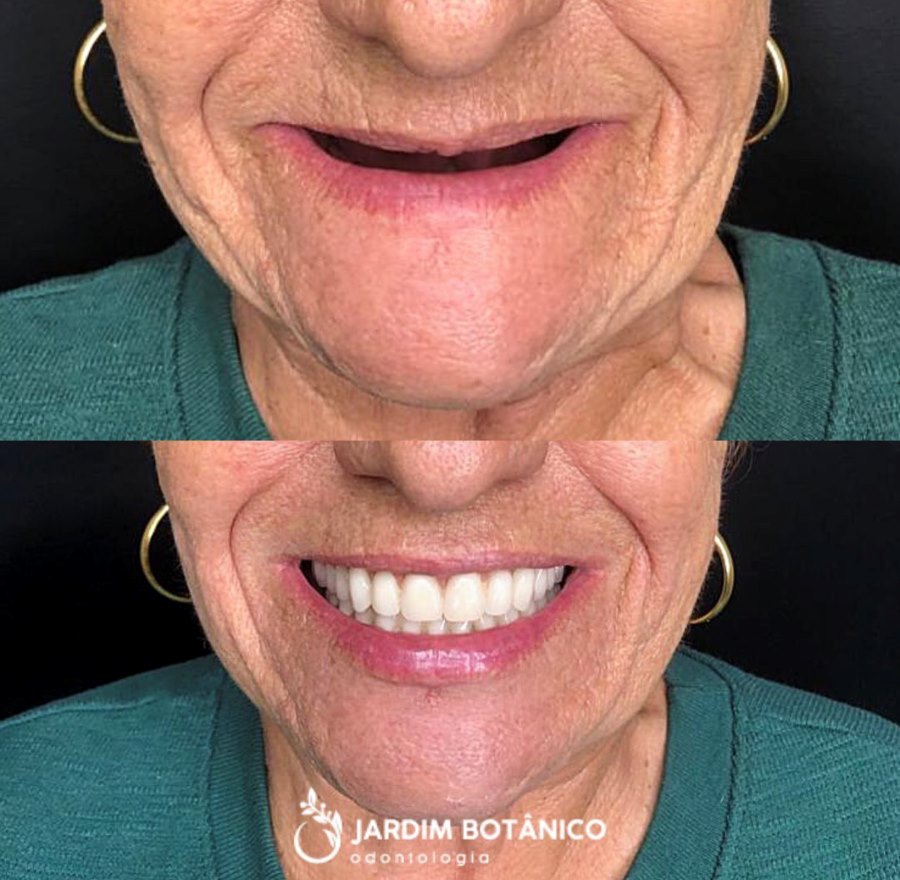 Paciente do Jardim Botânico Odontologia antes e depois da reabilitação com dentes fixos